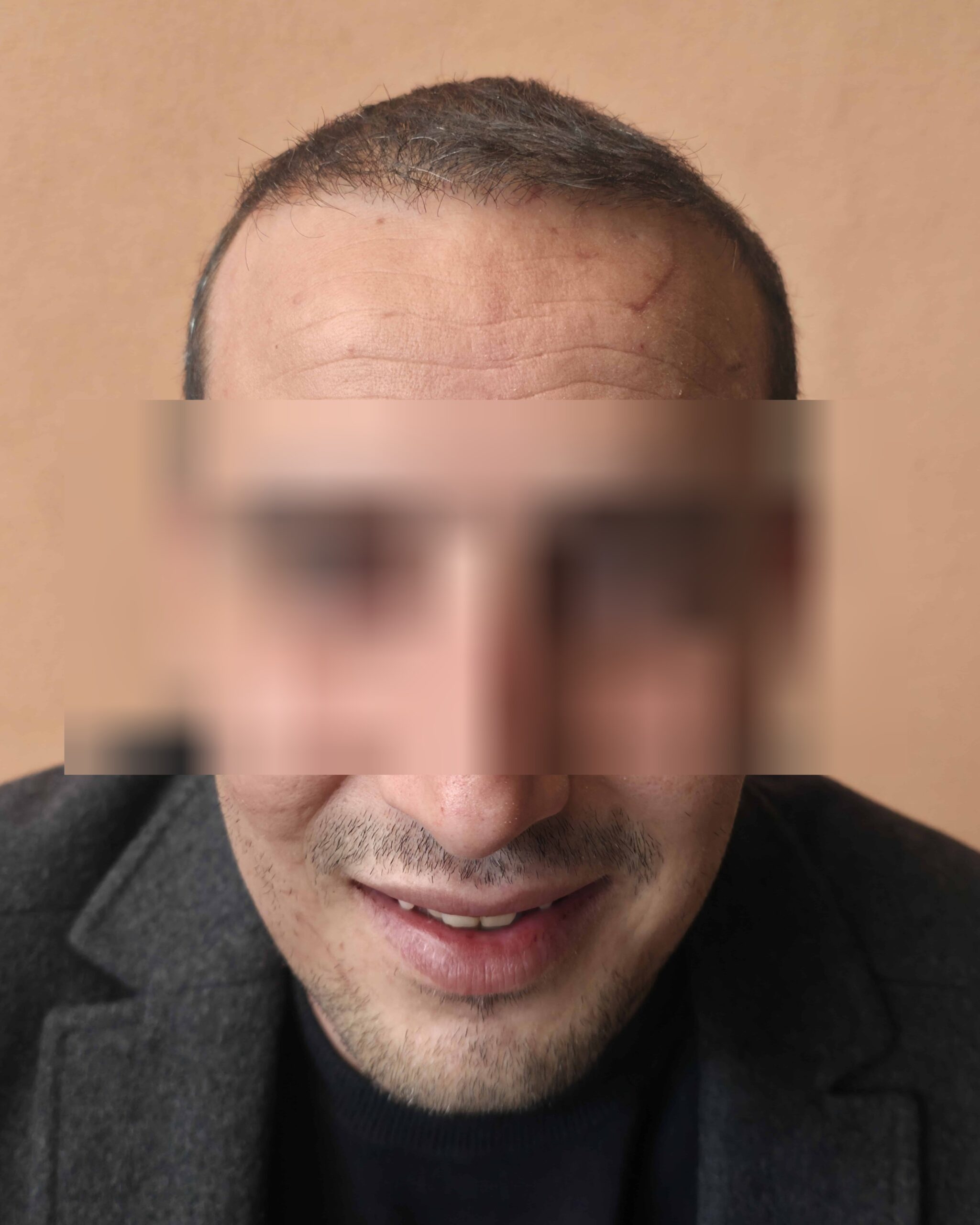 A., à 12 mois après greffe FUE (1800 greffons) — face