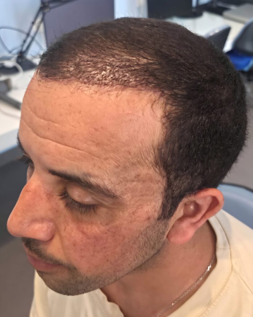 Hammouda — résultat après Long Hair FUE — profil gauche