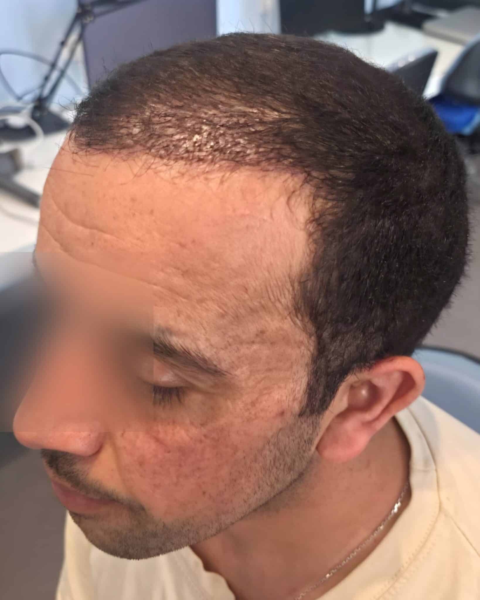 H., à J1 après Long Hair FUE (1500 greffons) — profil gauche