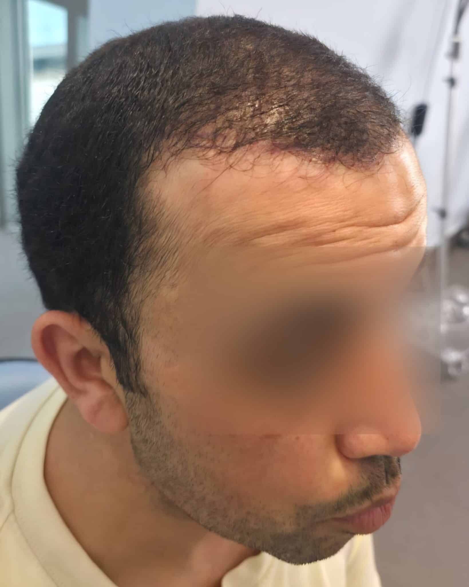 H., à J1 après Long Hair FUE (1500 greffons) — profil droit
