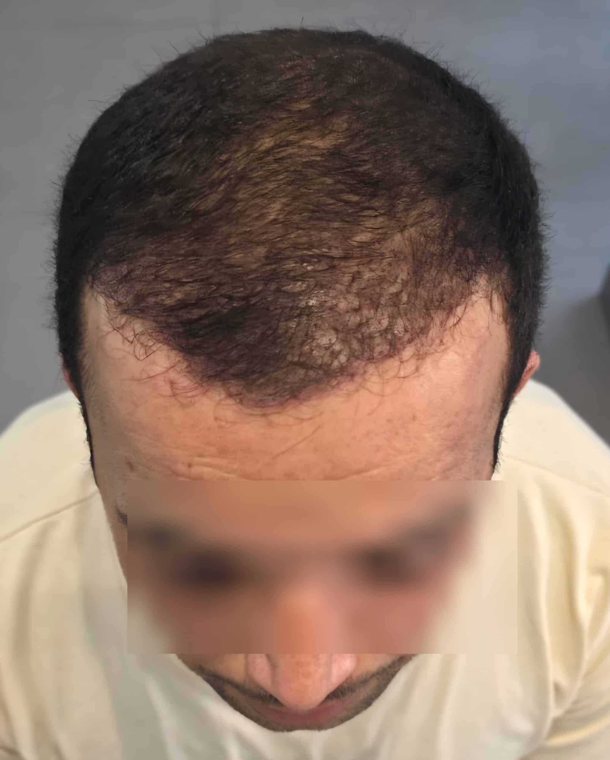H., à J1 après Long Hair FUE (1500 greffons) — face