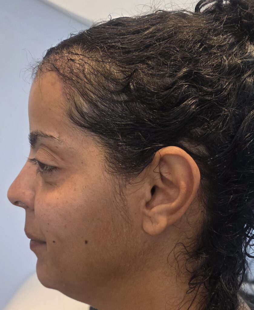 Marwa — résultat après Long Hair FUE — profil
