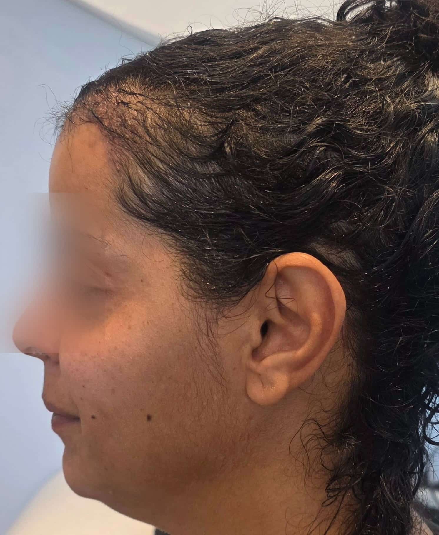 M., à J1 après Long Hair FUE (1500 greffons) — profil