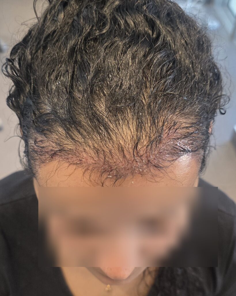 Marwa — résultat après Long Hair FUE — face