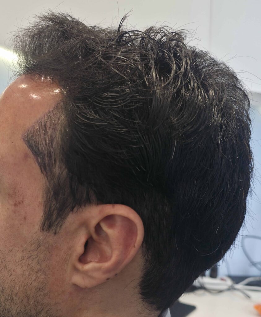 Riadh — résultat après Long Hair FUE — profil