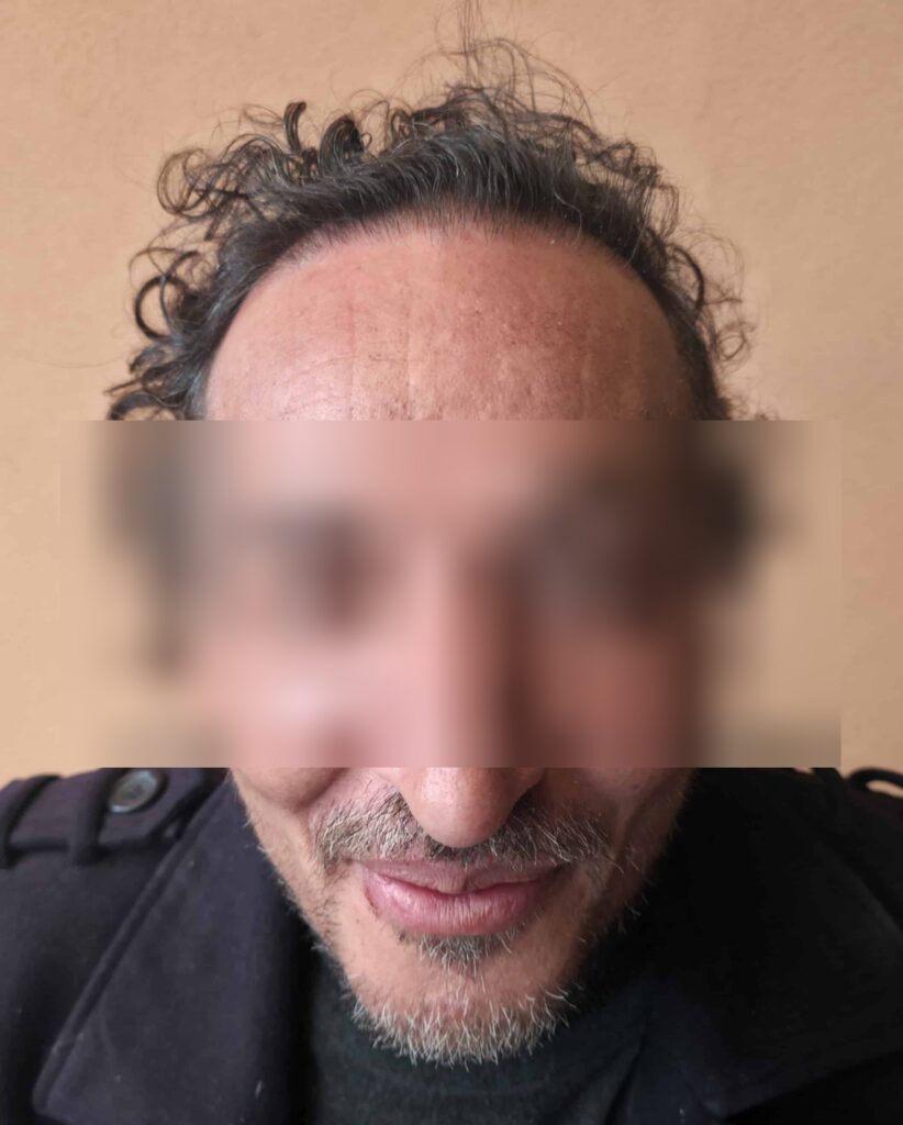 Yanis — résultat après Long Hair FUE — face