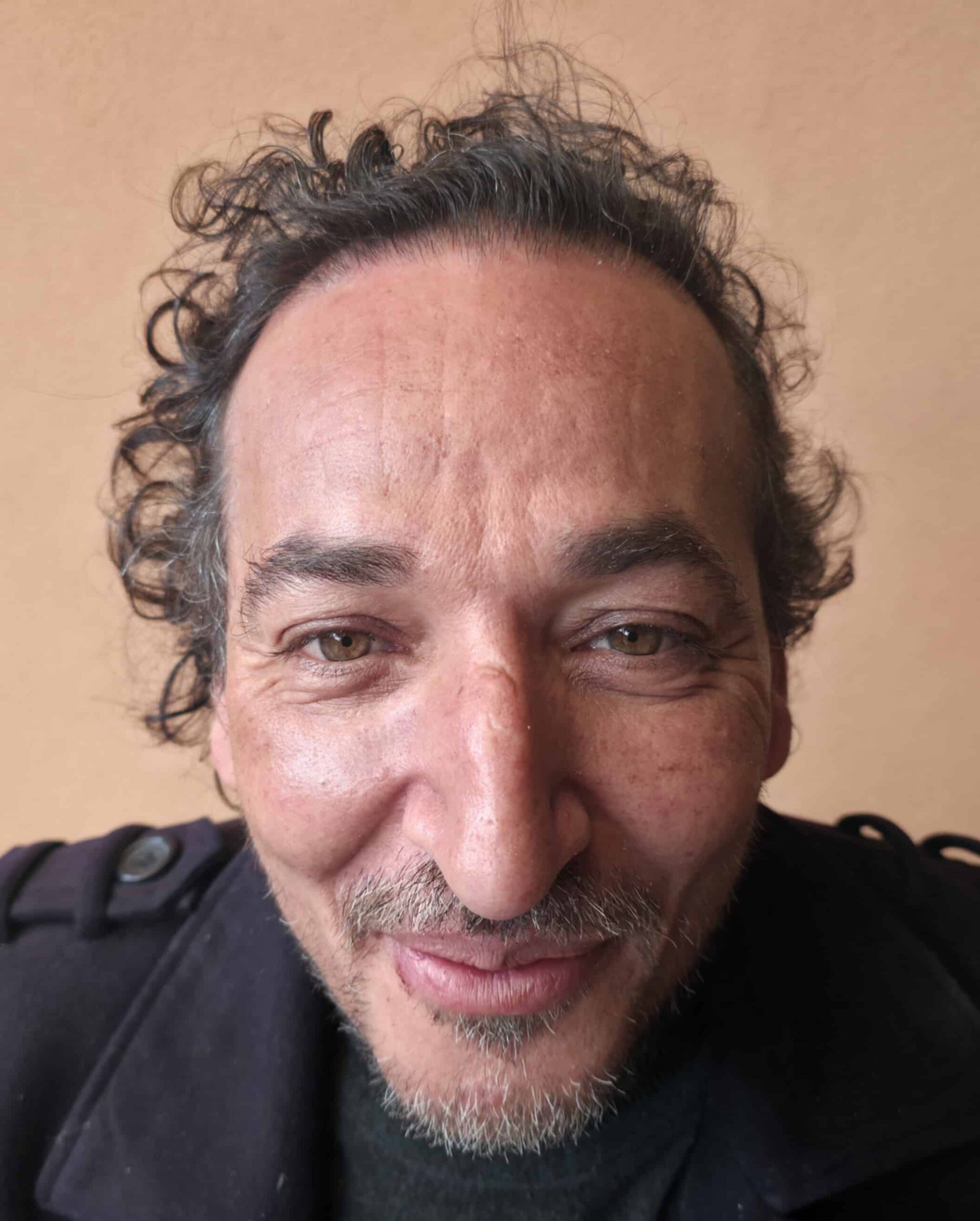Yanis, à 12 mois après greffe FUE (1600 greffons) — face