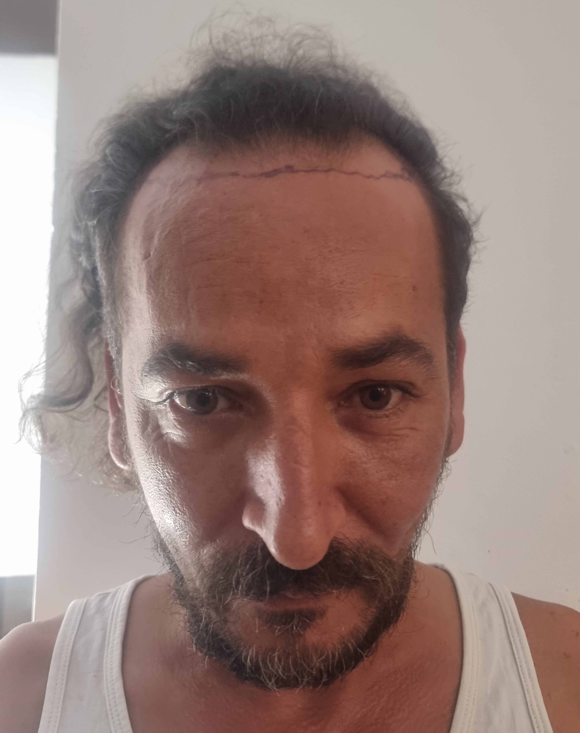 Yanis, avant greffe — face
