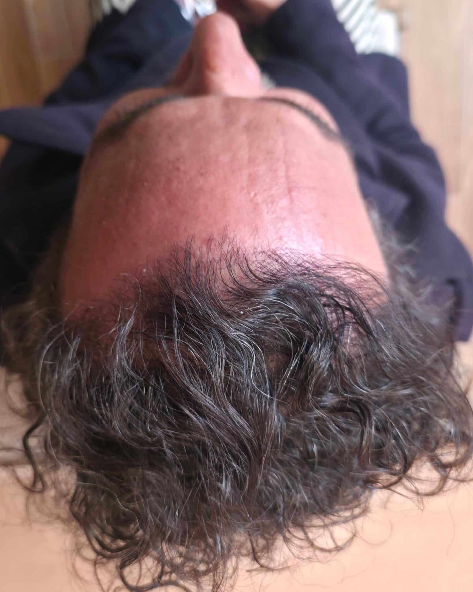 Y., à 12 mois après greffe FUE (1600 greffons) — vue du dessus