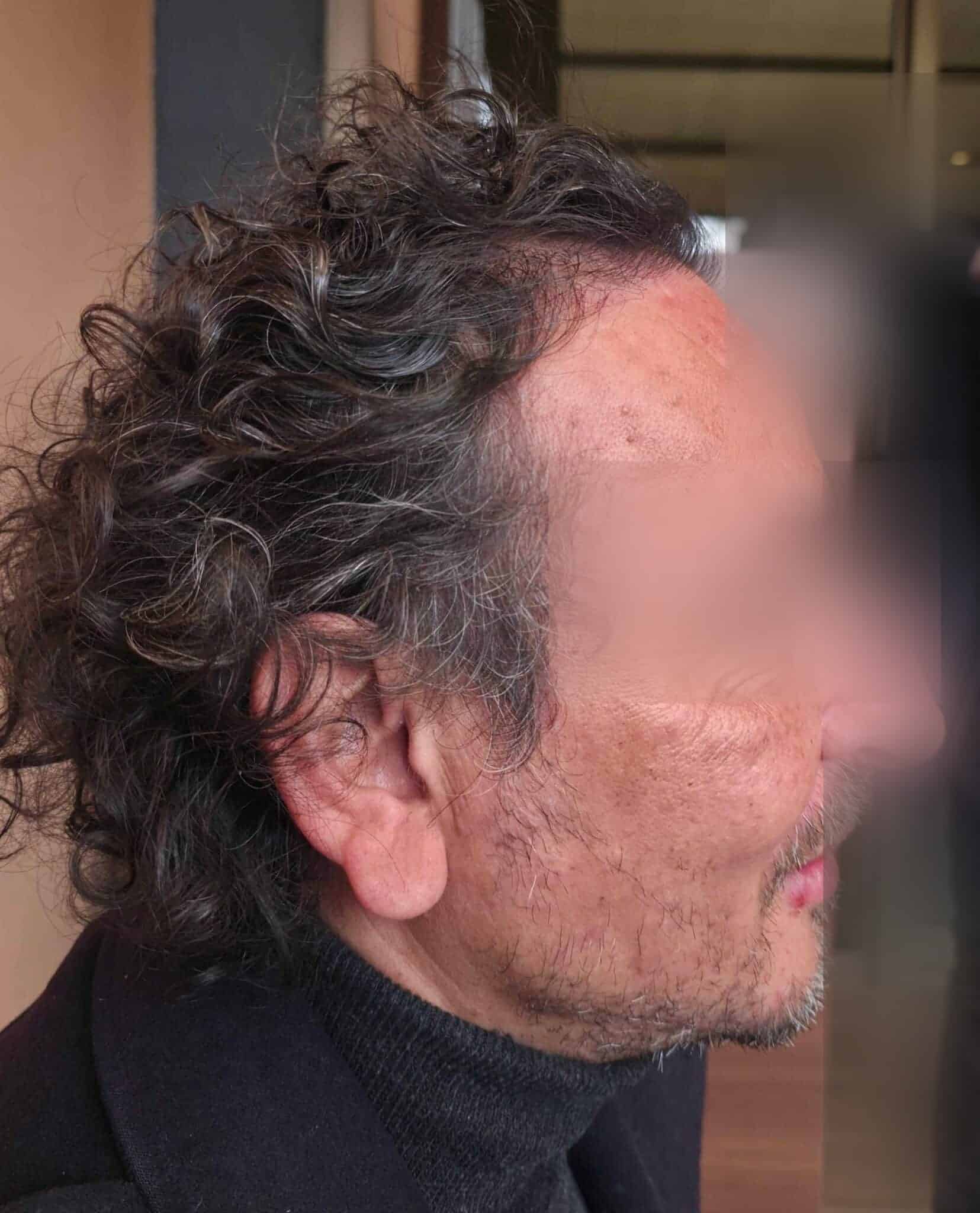 Y., à 12 mois après greffe FUE (1600 greffons) — profil