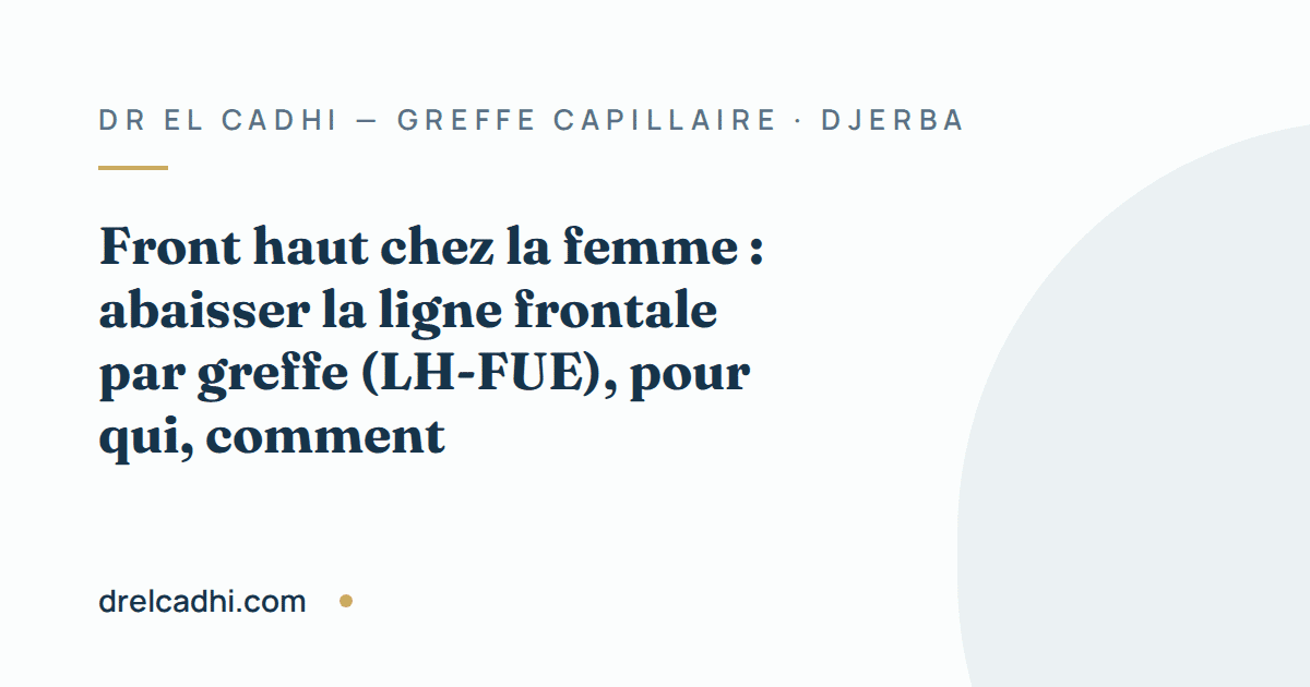 Illustration titrée de l’article « Front haut chez la femme : abaisser la ligne frontale par greffe (LH-FUE), pour qui, comment »