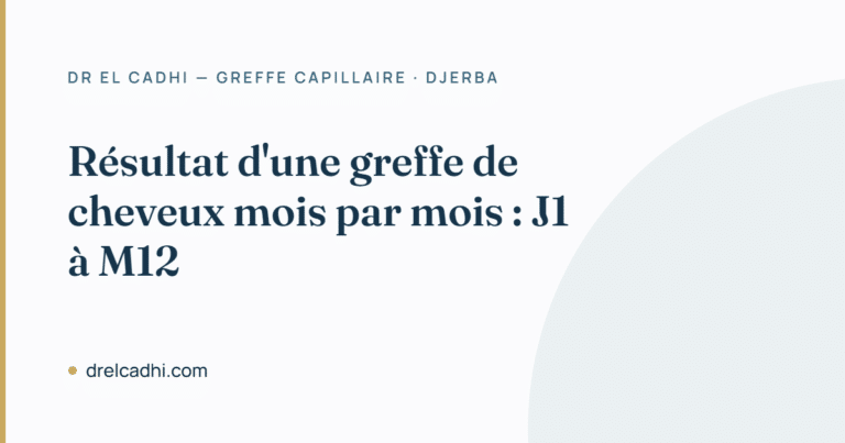 Résultat d'une greffe de cheveux mois par mois — Dr Khalil El Cadhi, Djerba