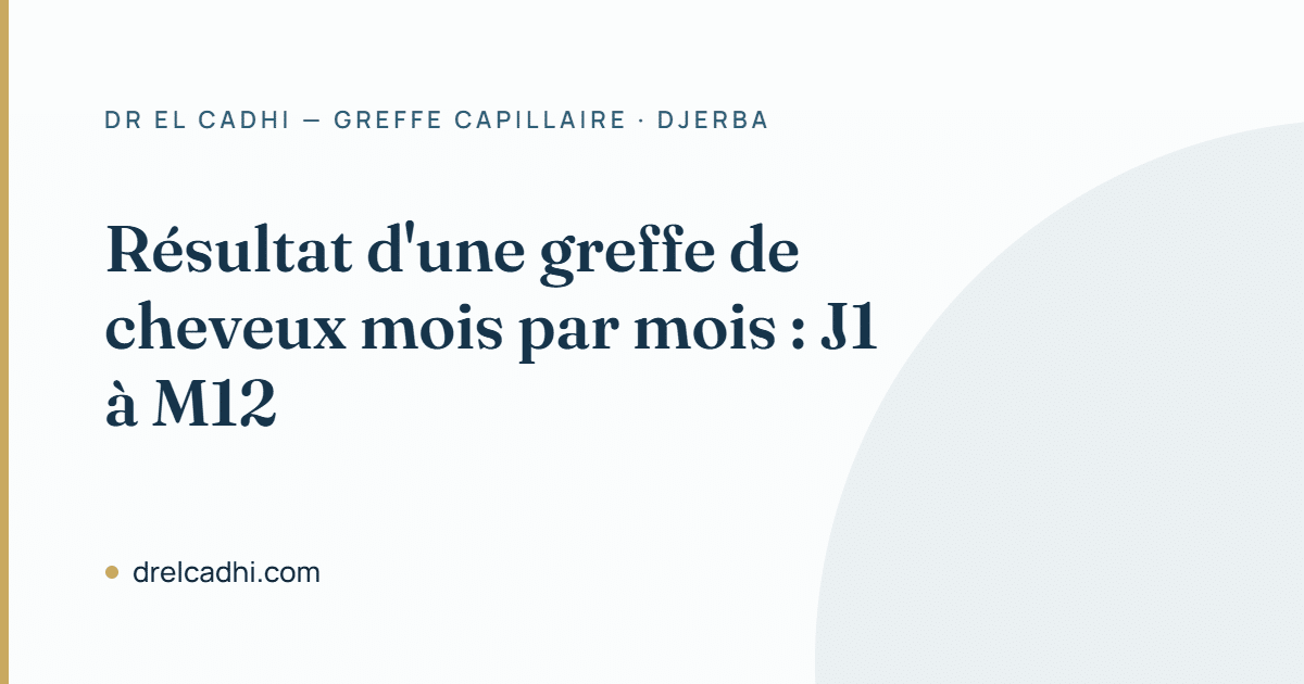 Résultat d'une greffe de cheveux mois par mois — Dr Khalil El Cadhi, Djerba